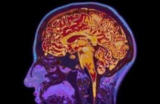 研究称人工智能技术有望提前6年侦测阿兹海默症征兆